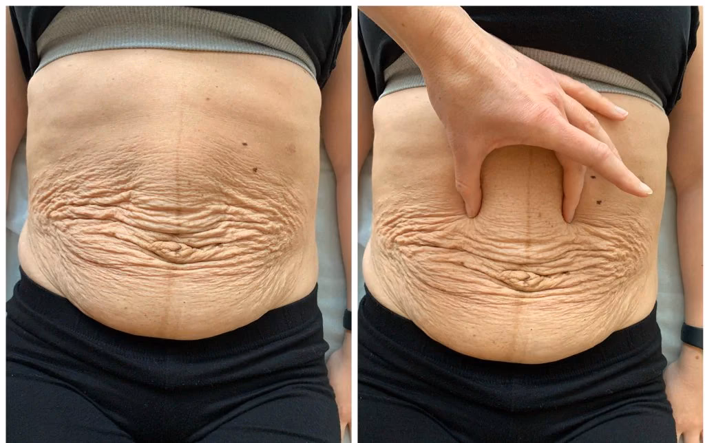 Kan delte mavemuskler trænes væk?