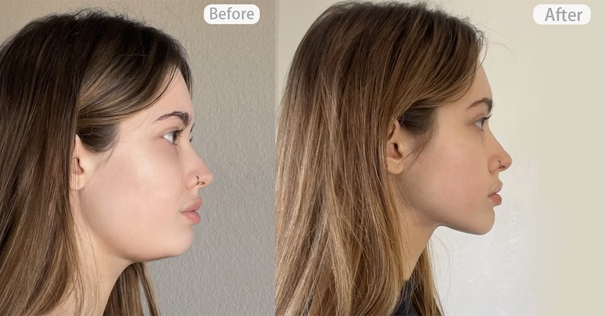 Is face yoga better than Botox?