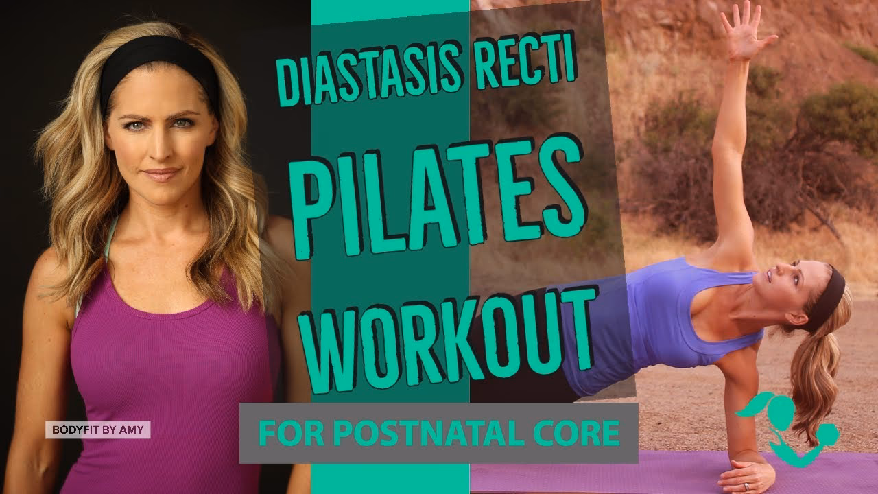 Can exercise correct diastasis recti?