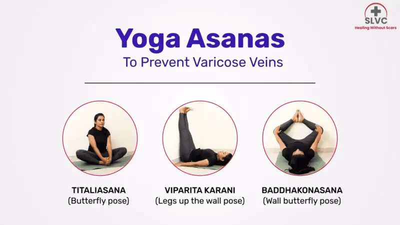 What exercise is best for varicose veins?